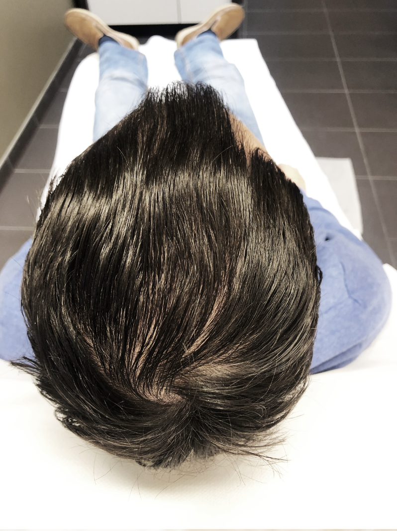 Androgén alopecia