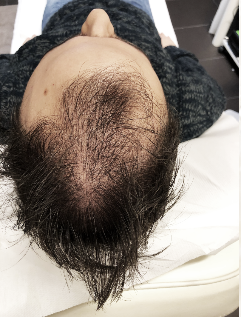 Androgén alopecia