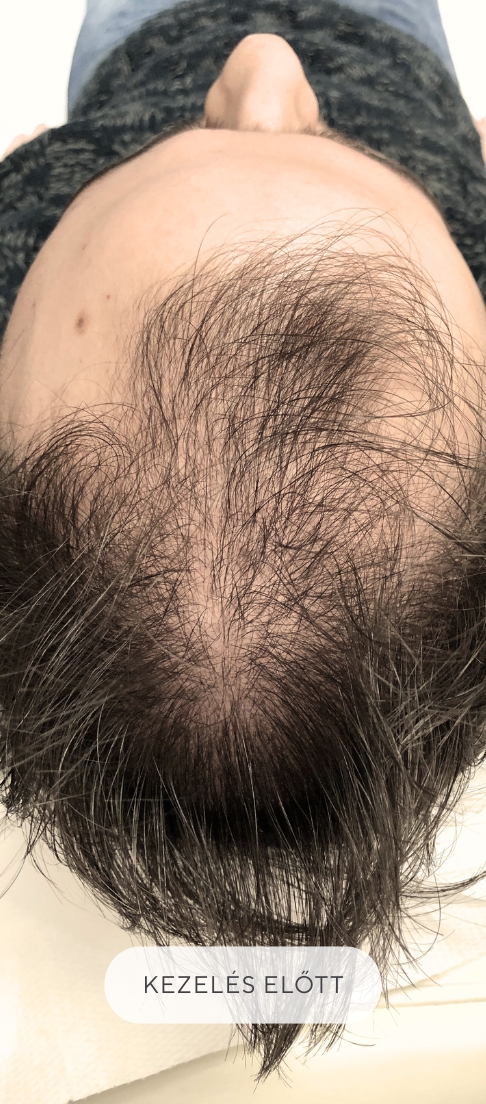 Covid utáni hajhullás