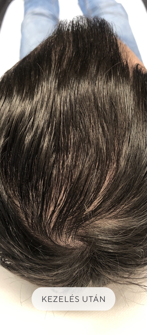 Covid utáni hajhullás